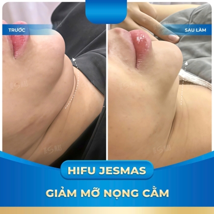 Dịch Vụ Giảm Mỡ Nọng Cằm