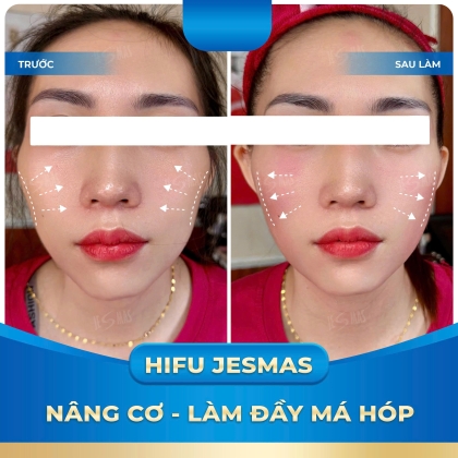 HIFU JESMAS NÂNG CƠ - LÀM ĐẦY MÁ HÓP
