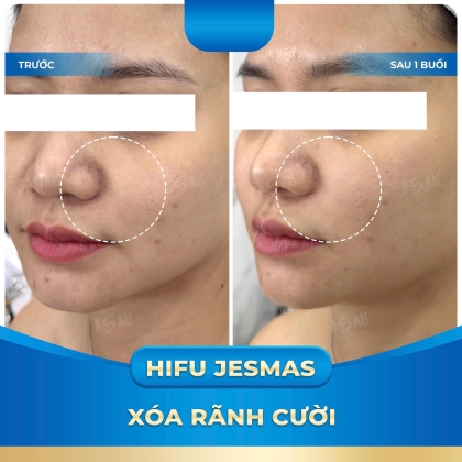 DỊCH VỤ HIFU XÓA RÃNH CƯỜI