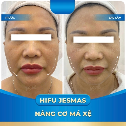 HIFU – Giải Pháp Cải Thiện Má Xệ Không Phẫu Thuật