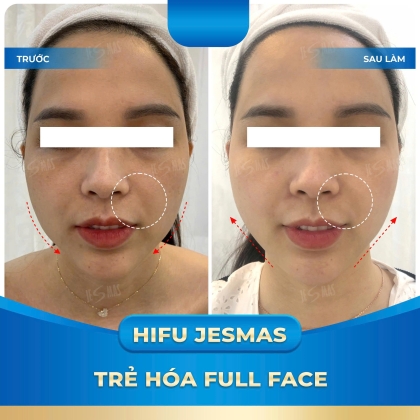 HIFU TRẺ HÓA TOÀN DIỆN