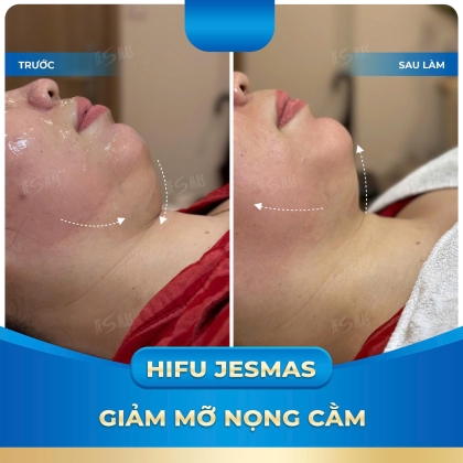 GIẢM MỠ NỌNG CẰM VỚI HIFU JESMAS