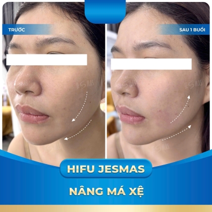 HIFU NÂNG MÁ XỆ