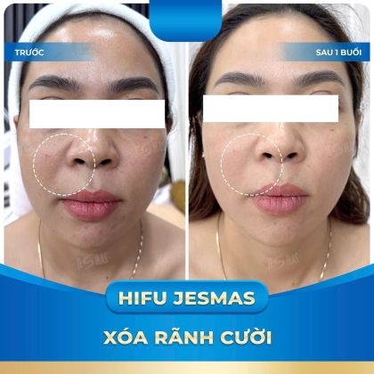 XÓA RÃNH CƯỜI VỚI HIFU JESMAS