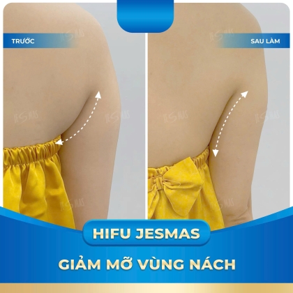 HIFU JESMAS GIẢM MỠ VÙNG NÁCH