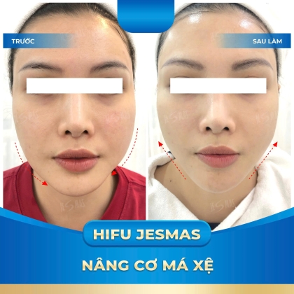 HIFU JESMAS NÂNG CƠ MÁ XỆ