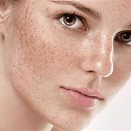 Chăm sóc da Tàn Nhang