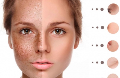 15+  Cách làm mờ tàn nhang chân sâu an toàn  nhanh nhất tại nhà  