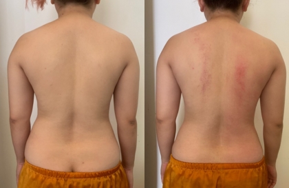 Cách giảm béo cho người huyết áp thấp - chế độ ăn - tập luyện