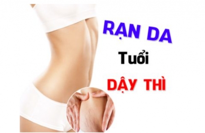 Cách trị rạn da tuổi dậy thì an toàn hiệu quả tại nhà