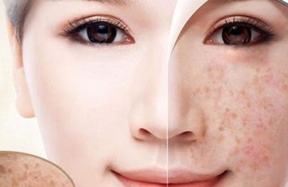 Tàn nhang bẩm sinh có chữa được không ? cách trị tàn nhang bẩm sinh an toàn