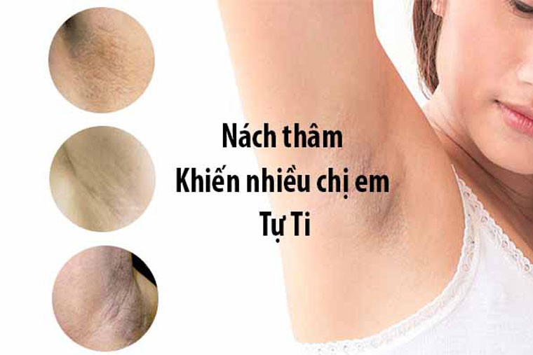 Cách trị Triệt lông nách an toàn uy tín tại sviet beuaty spa 