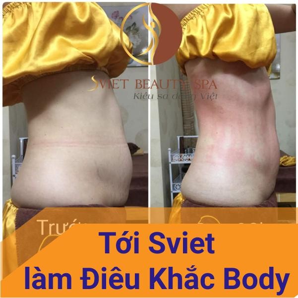 Dịch vụ giảm béo bụng sau sinh tại Sviet Beauty Spa hiệu quả - an toàn