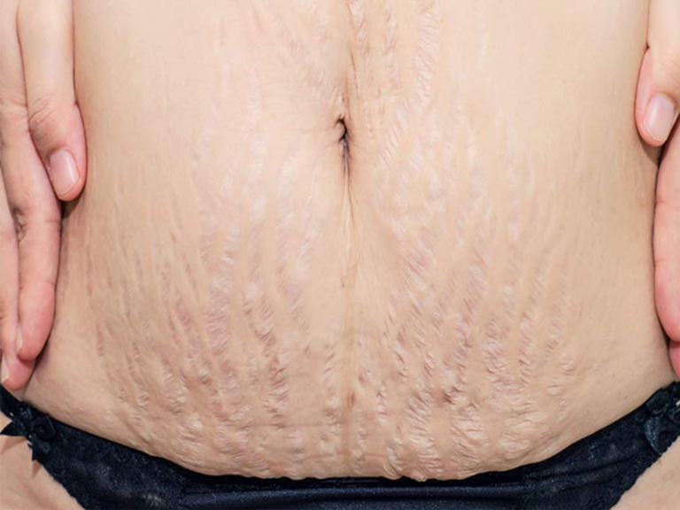 Rạn da tuổi dậy thì điều trị hiệu quả tại nhà