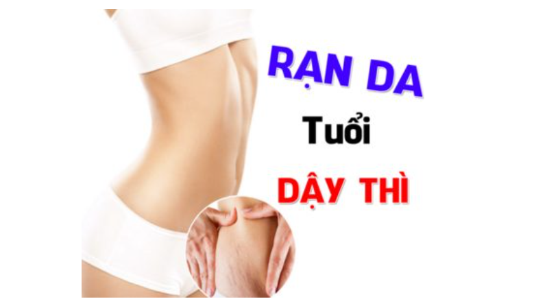 Bị rạn da tuổi dậy thì cách điều trị hiệu quả