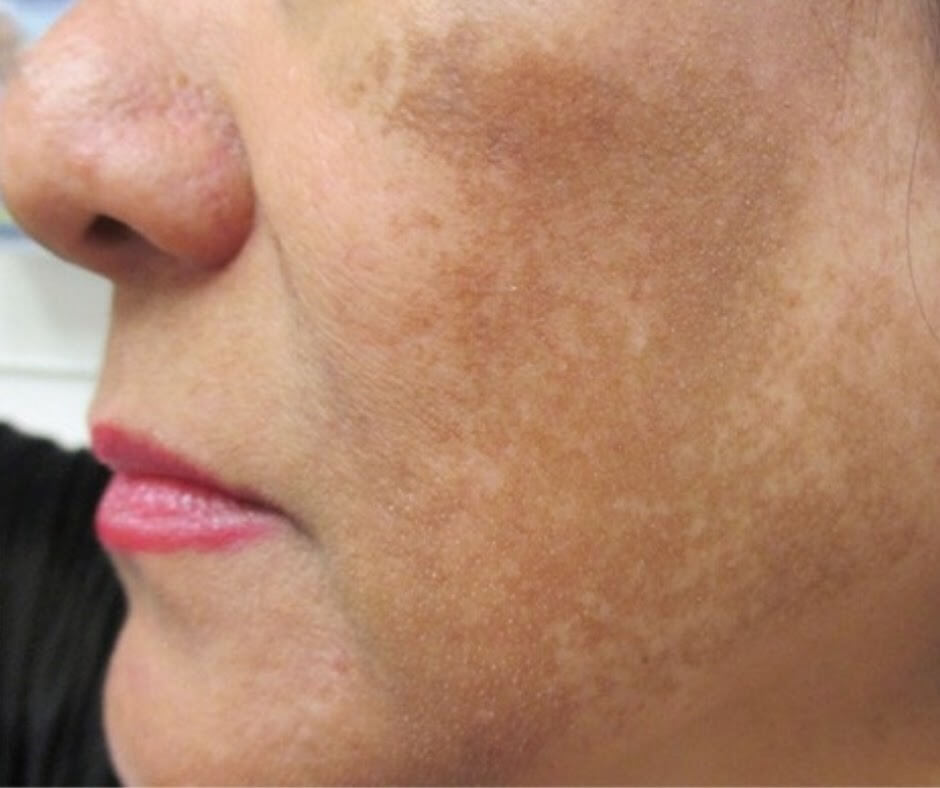 Tàn nhang chân sâu nguyên nhân cách điều trị hiệu quả tại nhà