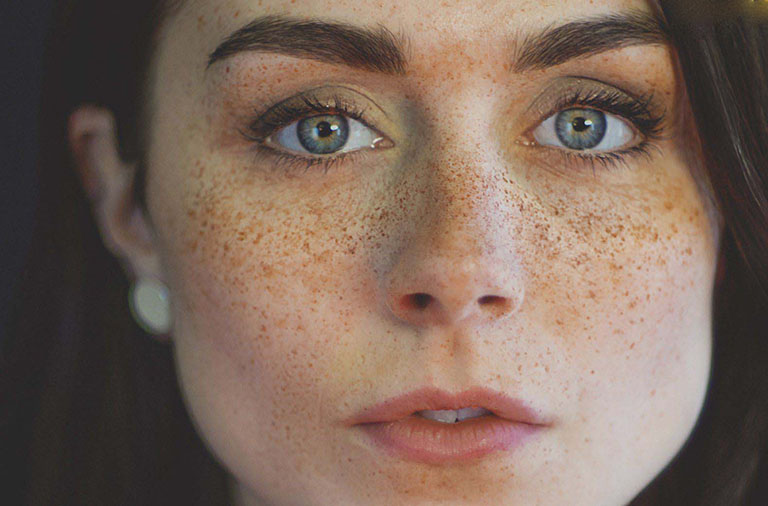 Tàn nhang chân sâu nguyên nhân cách điều trị hiệu quả tại nhà