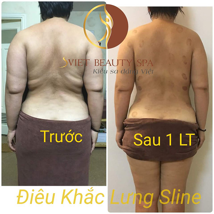 Khách hàng trải nghiệm 1 liệu trình điêu khắc body giảm béo tại Sviet Spa