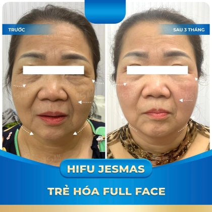 HIFU TRẺ HÓA FULL FACE