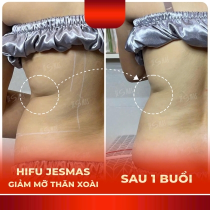 Dịch Vụ Hifu Giảm Mỡ Thăn Xoài