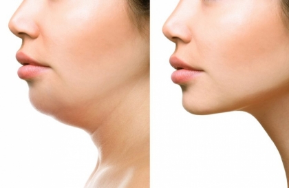 Giảm béo cổ bằng công nghệ cao có an toàn không ? 