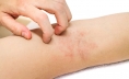 Triệt lông xong bị ngứa nguyên nhân – cách khắc phục