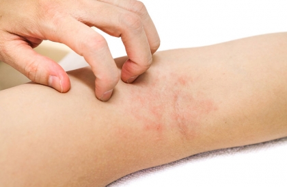 Triệt lông xong bị ngứa nguyên nhân – cách khắc phục