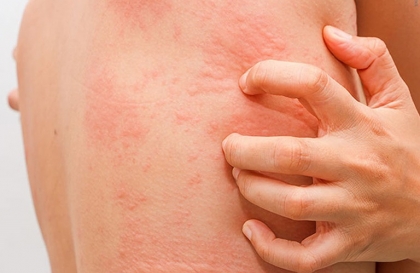 Sau khi triệt lông bị ngứa là vì sao ? Nguyên nhân và cách khắc phục