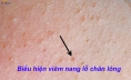 Bị viêm nang lông có nên triệt lông vĩnh viễn hay không