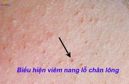 Bị viêm nang lông có nên triệt lông vĩnh viễn hay không