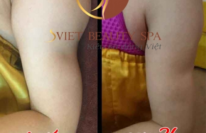 Những thông tin cần thiết cho việc giảm béo ở bắp tay