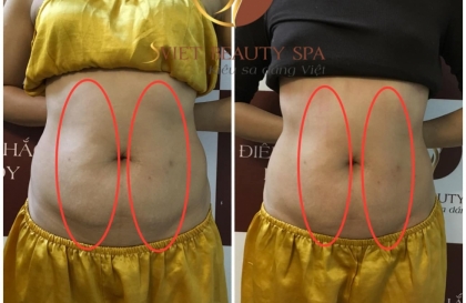 Hướng dẫn phương pháp giảm béo bụng dưới cho nữ hiệu quả 98%