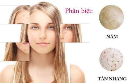 Sự khác biệt giữa nám và tàn nhang là gì - Cách điều trị?