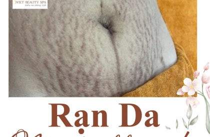 Điều trị rạn da bụng sau sinh – Nguyên nhân, biểu hiện và cách khắc phục