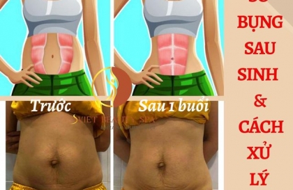 Sổ bụng sau sinh - Nhận biết - Cách xử lý -  giảm béo bụng sau sinh