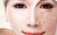 Tàn nhang bẩm sinh có chữa được không ? cách trị tàn nhang bẩm sinh an toàn