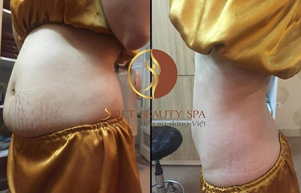 Dịch vụ điêu khắc giảm béo bằng máy siêu thanh vàng tại Sviet Beauty spa