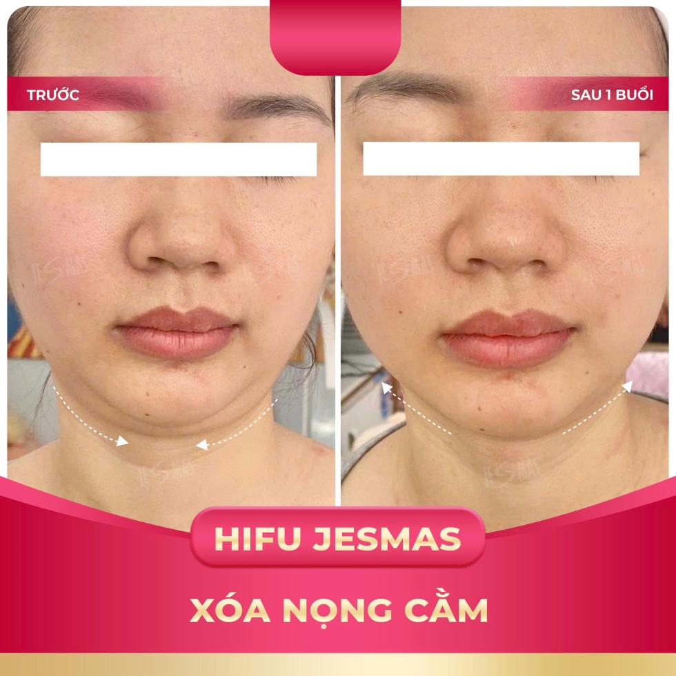 hifujesmasxoanongcamhong