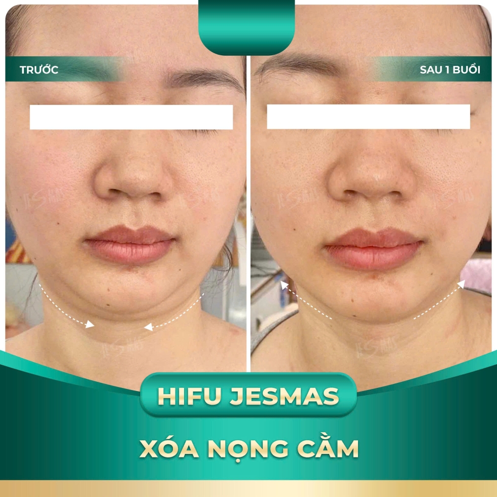 hifujesmasxoanongcamxanhnhat2