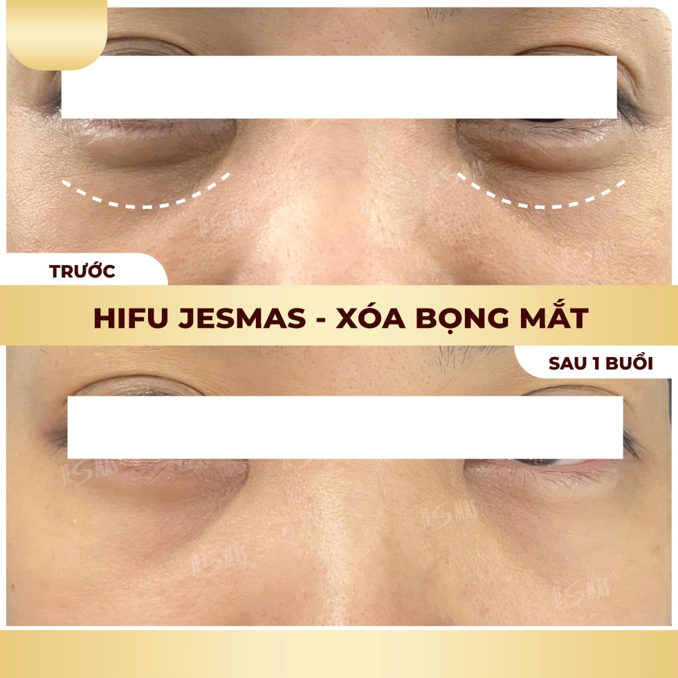 hifuxoabongmatvang