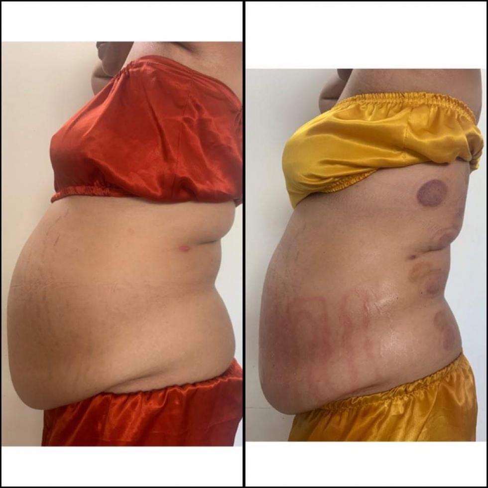 Béo bụng ở các độ tuổi khác nhau​