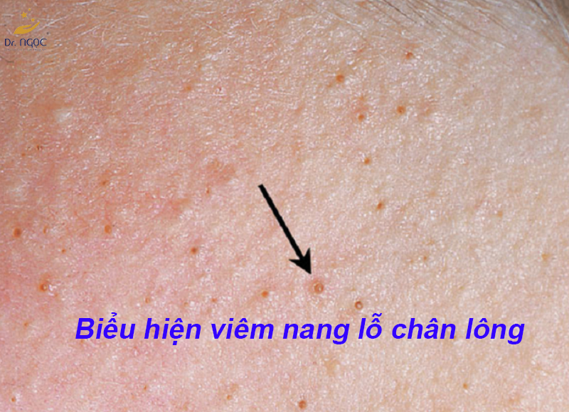 Biểu hiện viêm nang lỗ chân lông