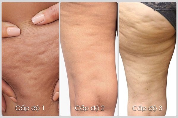 Giải pháp giảm béo hiệu quả cho từng dạng mỡ trong cơ thể