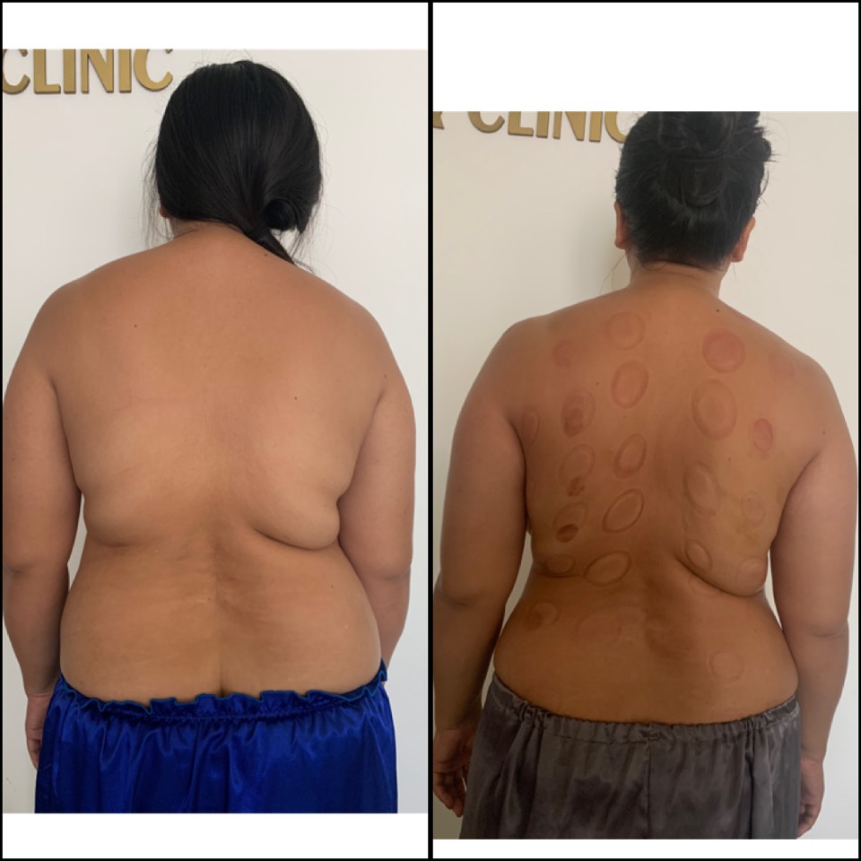 Giảm béo, giảm mỡ lưng tại nhà 