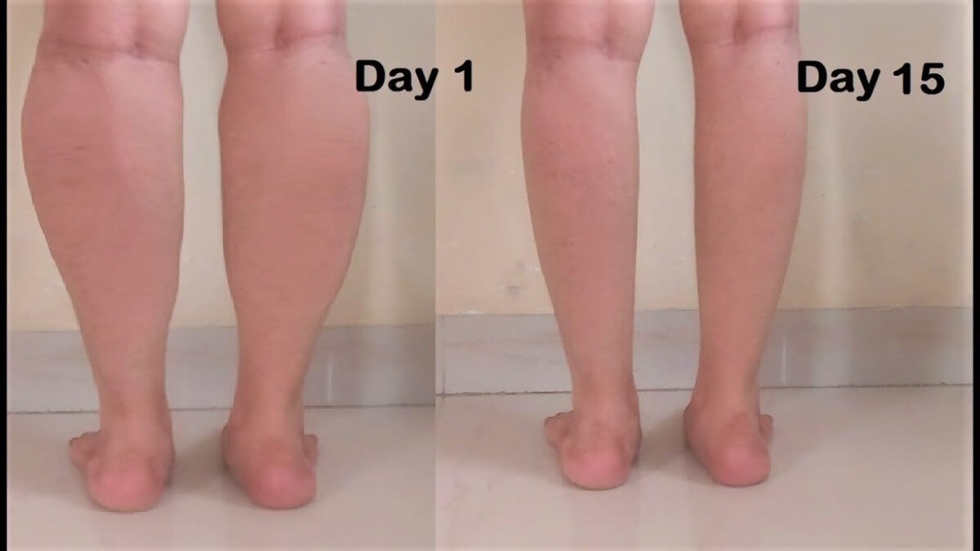 Công nghệ điêu khắc giảm béo bắp chân an toàn,hiệu quả tại Sviet Beauty spa