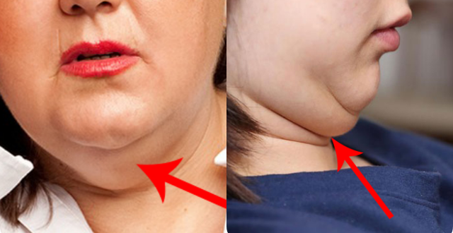 Giảm béo cổ bằng công nghệ cao có thực sự an toàn