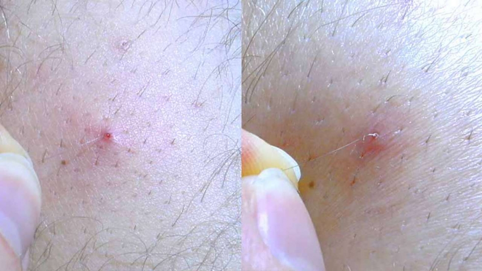 Mụn suất hiện trên da mụn gây ảnh hưởng