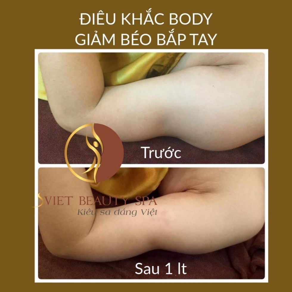 Dịch vụ giảm béo Bắp Tay tại Sviet Beauty Spa