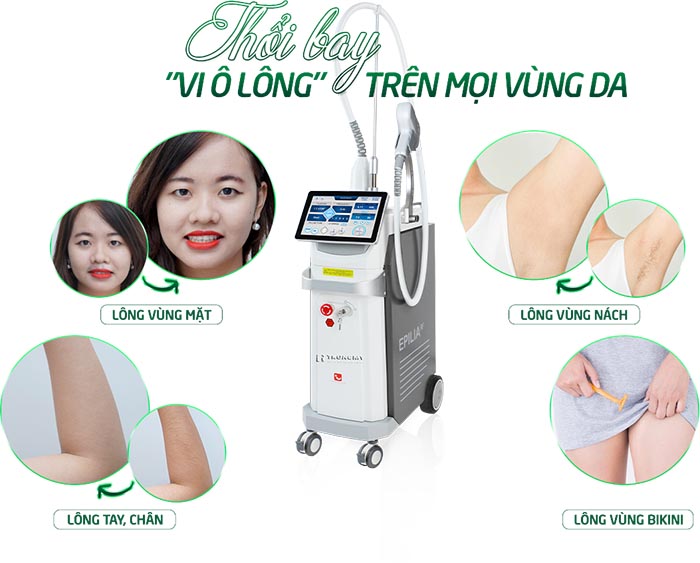 Dịch vụ triệt lông vĩnh viễn tại Sviet Spa