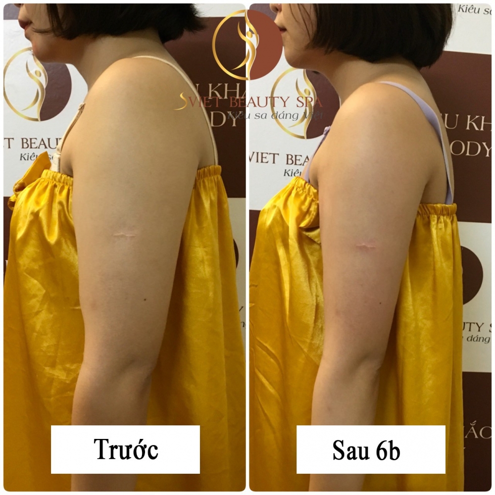 dịch vụ giảm béo cánh tay tại sviet beauty spa